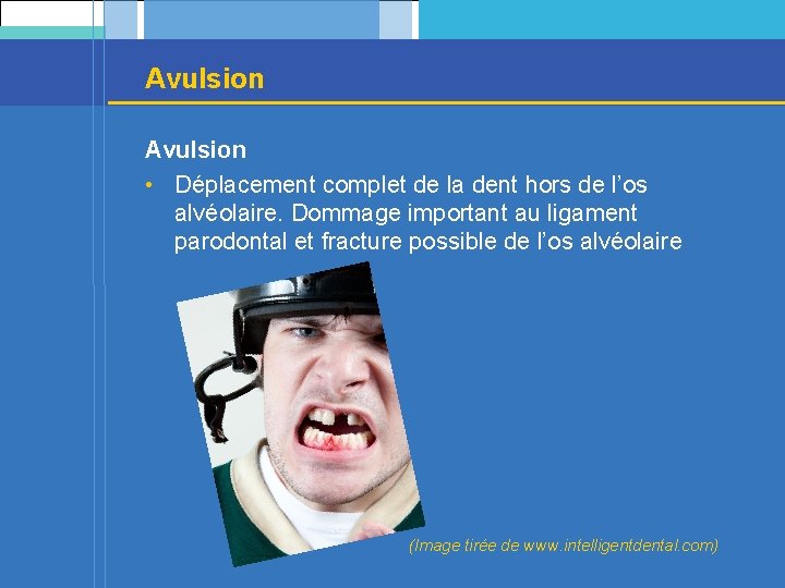 Avulsion • Déplacement complet de la dent hors de l’os alvéolaire. Dommage important au