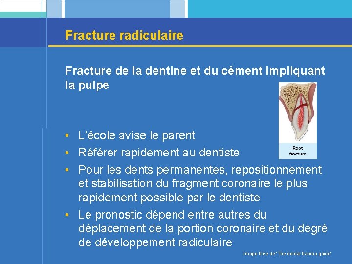 Fracture radiculaire Fracture de la dentine et du cément impliquant la pulpe • L’école