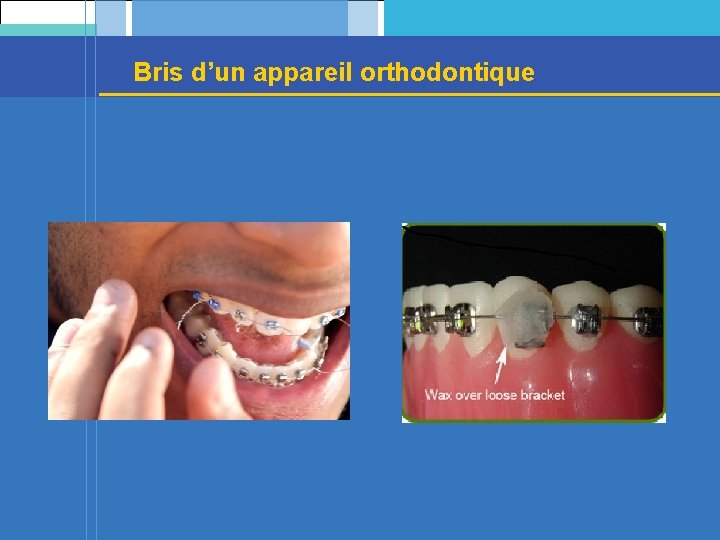 Bris d’un appareil orthodontique 