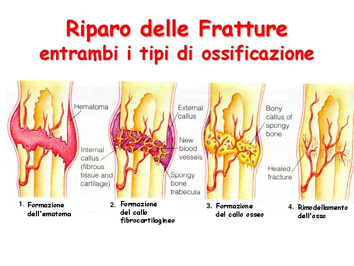 Riparo delle Fratture entrambi i tipi di ossificazione Formazione dell'ematoma Formazione del callo fibrocartilagineo Riparo delle Fratture entrambi i tipi di ossificazione Formazione dell'ematoma Formazione del callo fibrocartilagineo