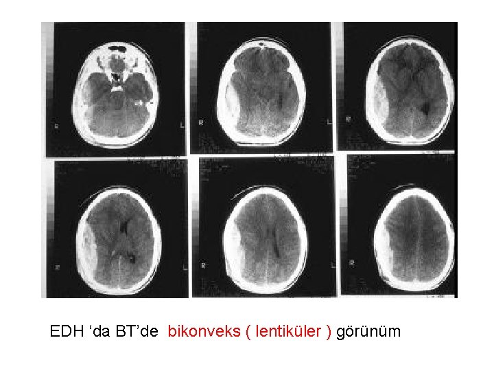 EDH ‘da BT’de bikonveks ( lentiküler ) görünüm 