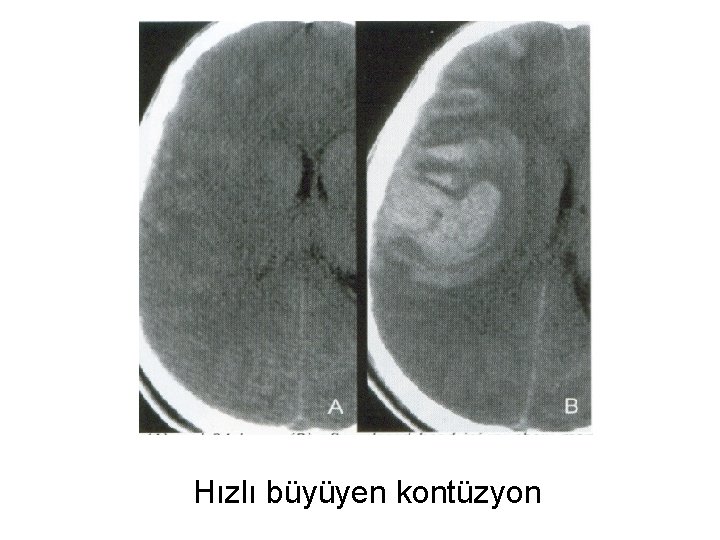 Hızlı büyüyen kontüzyon 