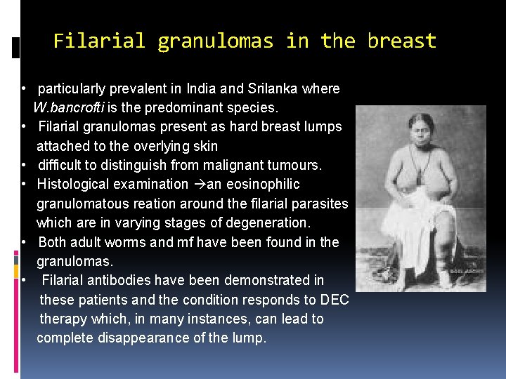 Filarial granulomas in the breast • particularly prevalent in India and Srilanka where W.