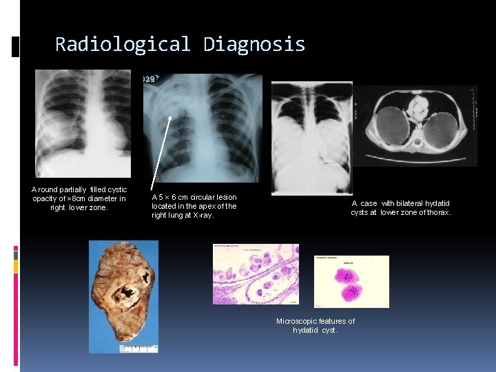 Radiological Diagnosis A round partially filled cystic opacity of >8 cm diameter in right