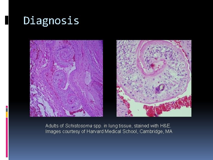 Diagnosis Adults of Schistosoma spp. in lung tissue, stained with H&E. Images courtesy of