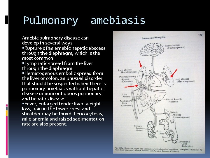 Pulmonary amebiasis Amebic pulmonary disease can develop in several ways Rupture of an amebic