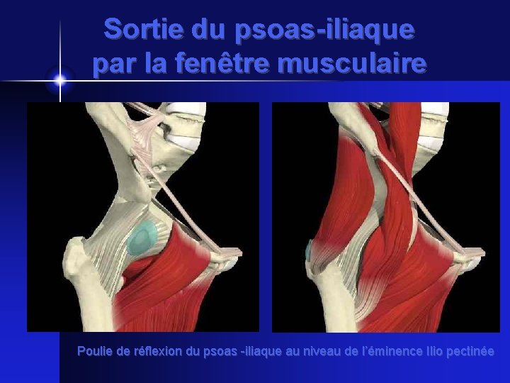 Sortie du psoas-iliaque par la fenêtre musculaire Poulie de réflexion du psoas -iliaque au