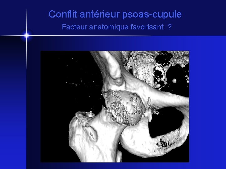 Conflit antérieur psoas-cupule Facteur anatomique favorisant ? 