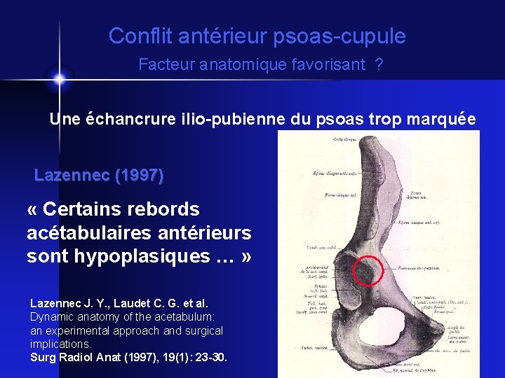 Conflit antérieur psoas-cupule Facteur anatomique favorisant ? Une échancrure ilio-pubienne du psoas trop marquée