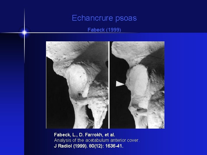 Echancrure psoas Fabeck (1999) Fabeck, L. , D. Farrokh, et al. Analysis of the