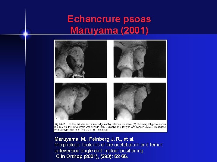 Echancrure psoas Maruyama (2001) Maruyama, M. , Feinberg J. R. , et al. Morphologic