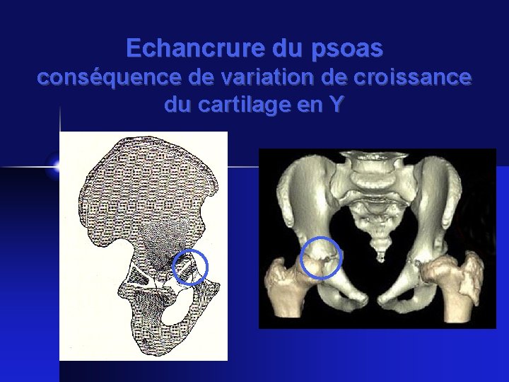 Echancrure du psoas conséquence de variation de croissance du cartilage en Y 