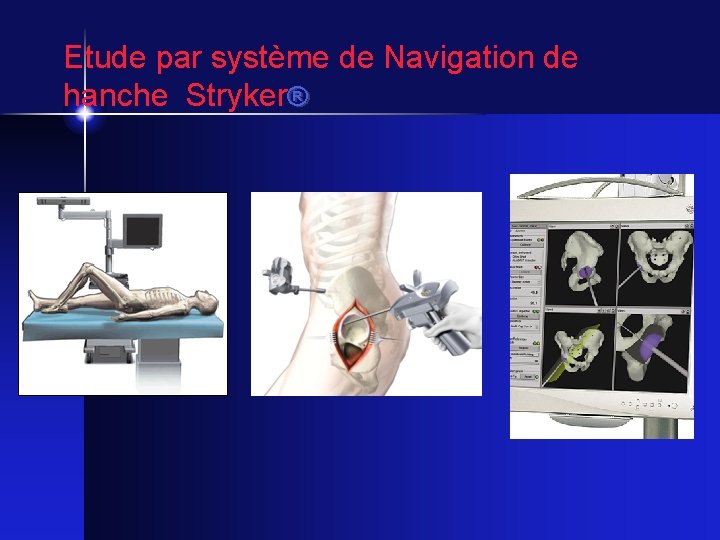 Etude par système de Navigation de hanche Stryker® 
