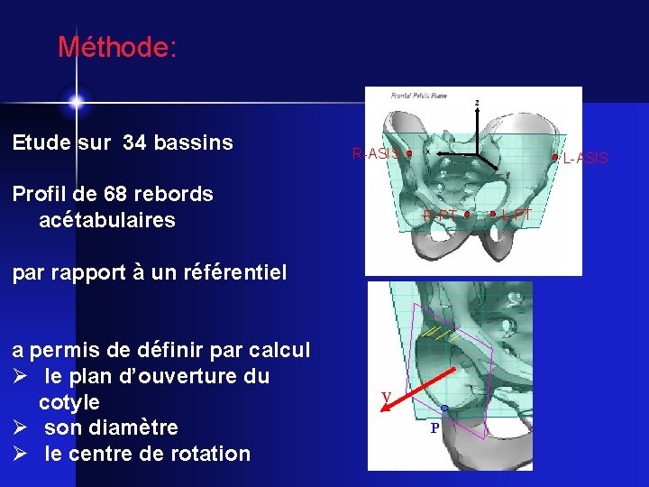 Méthode: Etude sur 34 bassins R-ASIS Profil de 68 rebords acétabulaires L-ASIS R-PT par