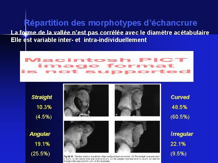 Répartition des morphotypes d’échancrure La forme de la vallée n’est pas corrélée avec le