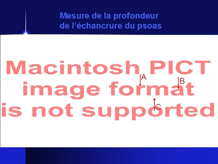 Mesure de la profondeur de l’échancrure du psoas A B C 