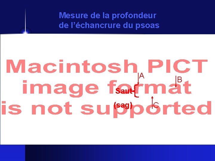 Mesure de la profondeur de l’échancrure du psoas A B Saut (sag) C 