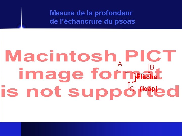 Mesure de la profondeur de l’échancrure du psoas A B Flèche C (leap) 