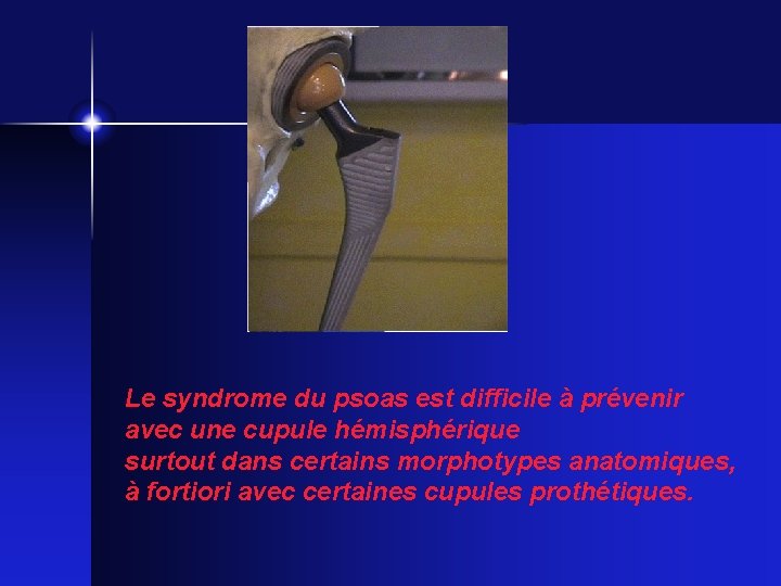 Le syndrome du psoas est difficile à prévenir avec une cupule hémisphérique surtout dans