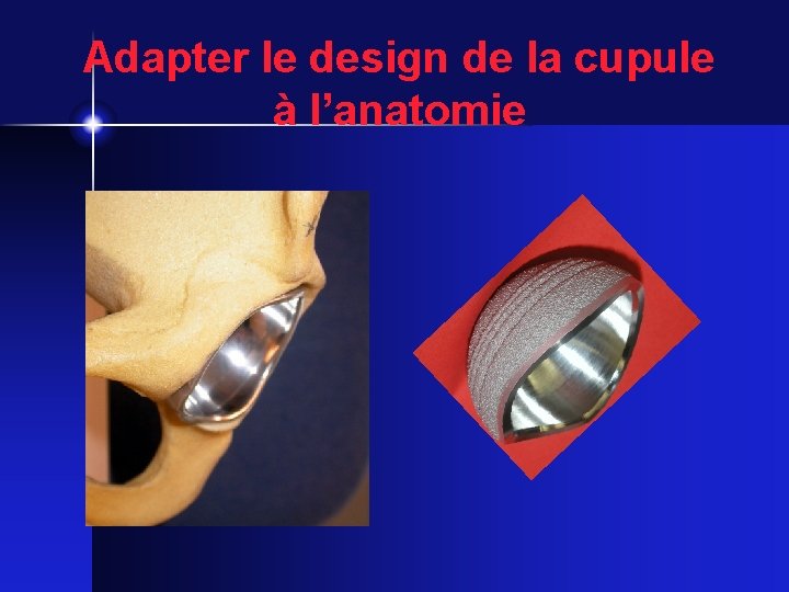 Adapter le design de la cupule à l’anatomie 