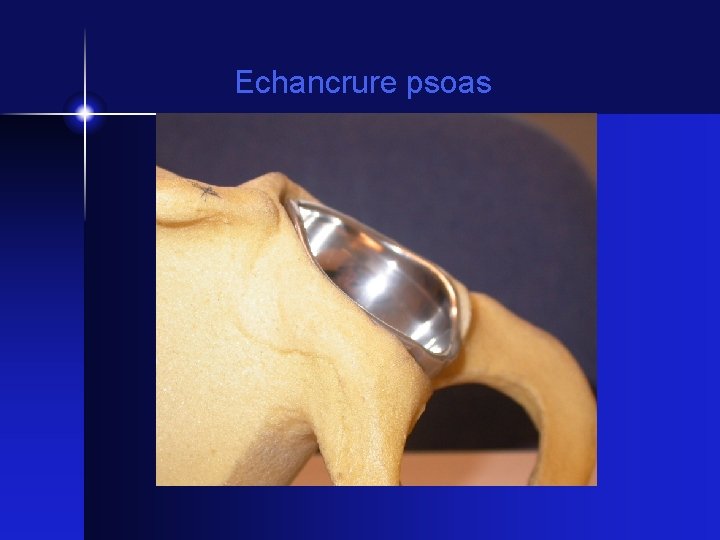 Echancrure psoas 