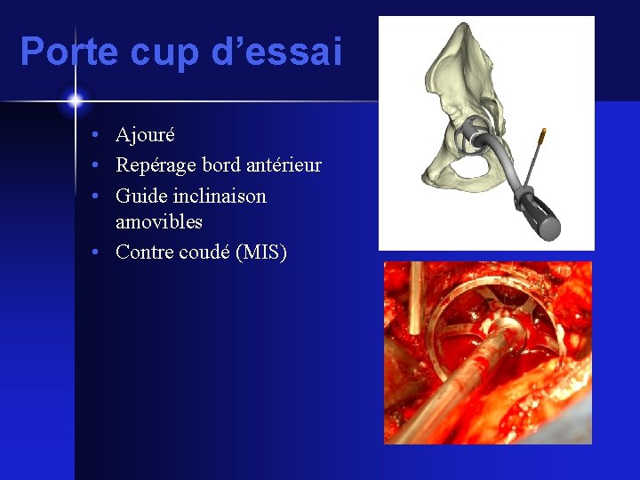 Porte cup d’essai • Ajouré • Repérage bord antérieur • Guide inclinaison amovibles •