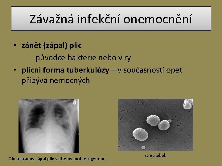 Závažná infekční onemocnění • zánět (zápal) plic původce bakterie nebo viry • plicní forma