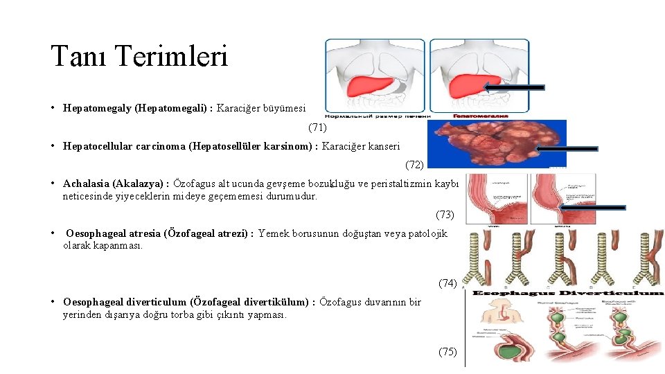 Tanı Terimleri • Hepatomegaly (Hepatomegali) : Karaciğer büyümesi (71) • Hepatocellular carcinoma (Hepatosellüler karsinom)