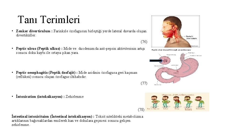 Tanı Terimleri • Zenker diverticulum : Farinksle özofagusun birleştiği yerde lateral duvarda oluşan divertiküller.