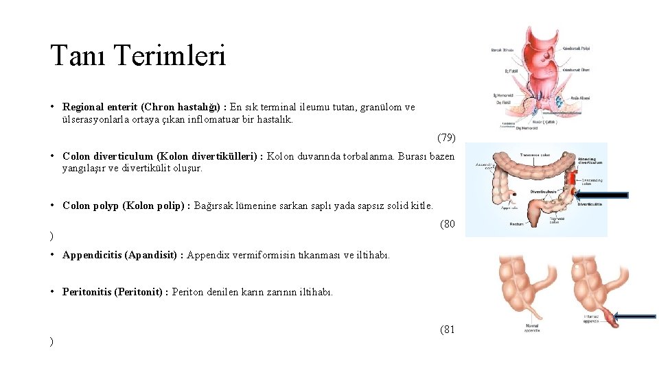 Tanı Terimleri • Regional enterit (Chron hastalığı) : En sık terminal ileumu tutan, granülom