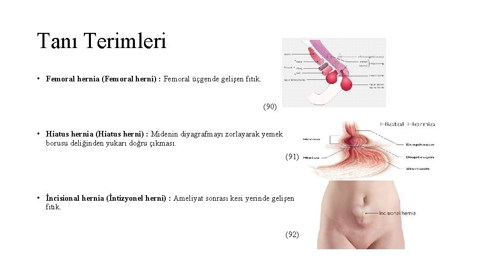 Tanı Terimleri • Femoral hernia (Femoral herni) : Femoral üçgende gelişen fıtık. (90) •