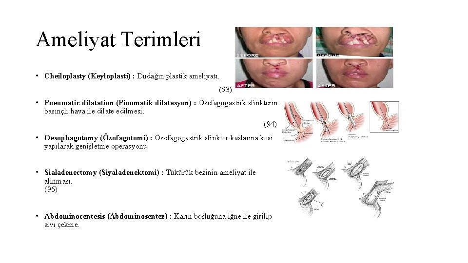 Ameliyat Terimleri • Cheiloplasty (Keyloplasti) : Dudağın plastik ameliyatı. (93) • Pneumatic dilatation (Pinomatik