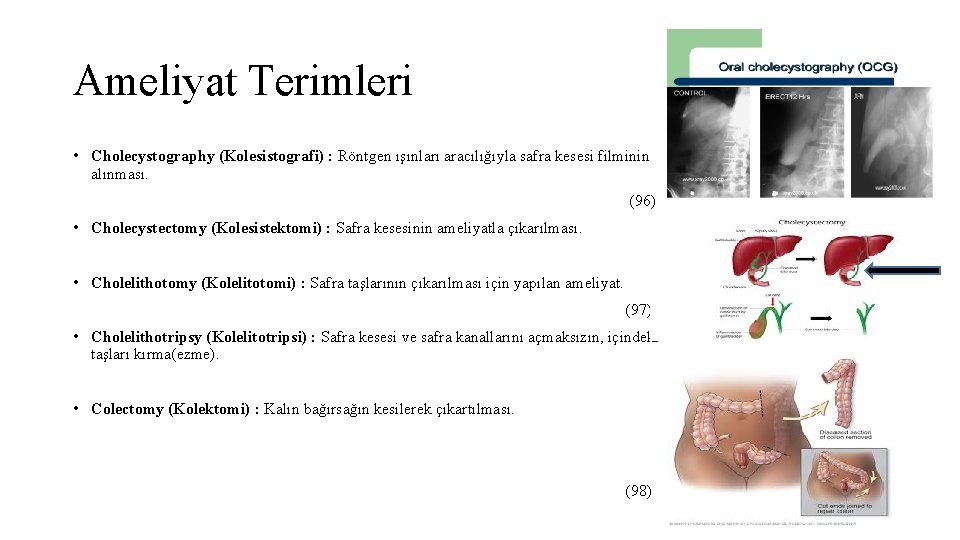 Ameliyat Terimleri • Cholecystography (Kolesistografi) : Röntgen ışınları aracılığıyla safra kesesi filminin alınması. (96)