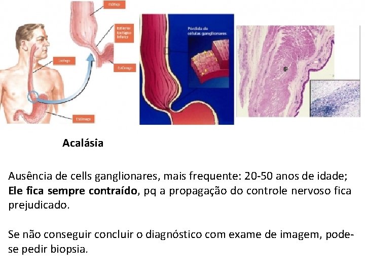 Acalásia Ausência de cells ganglionares, mais frequente: 20 -50 anos de idade; Ele fica Acalásia Ausência de cells ganglionares, mais frequente: 20 -50 anos de idade; Ele fica