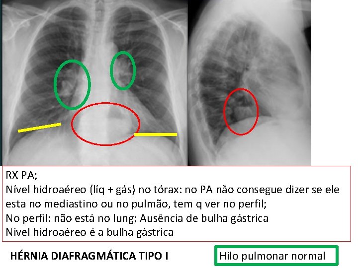RX PA; Nível hidroaéreo (líq + gás) no tórax: no PA não consegue dizer RX PA; Nível hidroaéreo (líq + gás) no tórax: no PA não consegue dizer