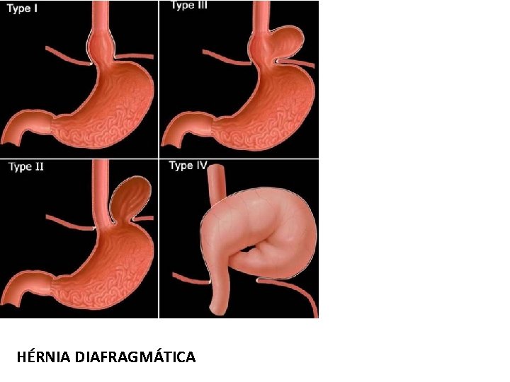HÉRNIA DIAFRAGMÁTICA HÉRNIA DIAFRAGMÁTICA