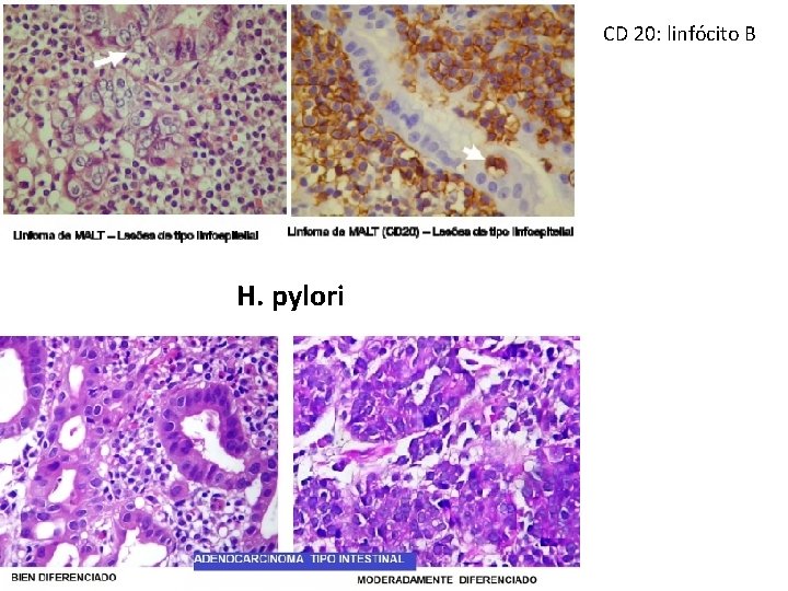 CD 20: linfócito B H. pylori CD 20: linfócito B H. pylori
