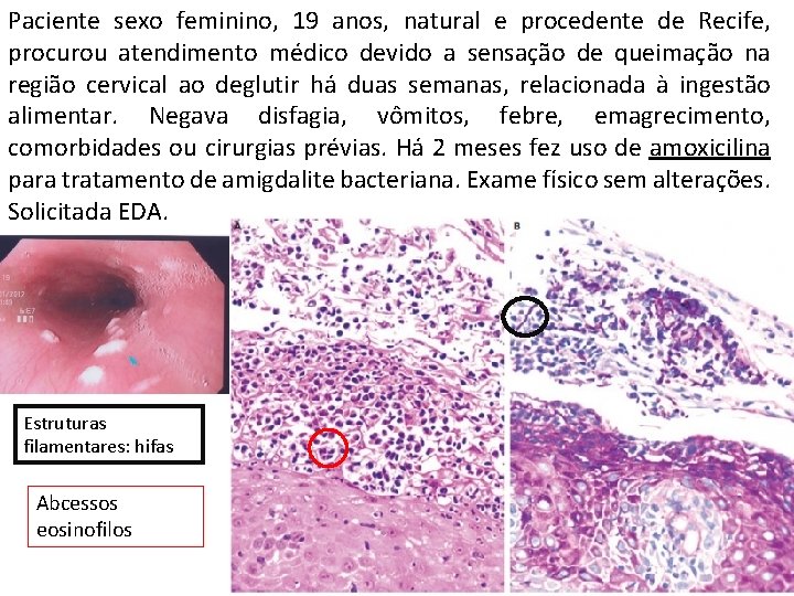 Paciente sexo feminino, 19 anos, natural e procedente de Recife, procurou atendimento médico devido Paciente sexo feminino, 19 anos, natural e procedente de Recife, procurou atendimento médico devido