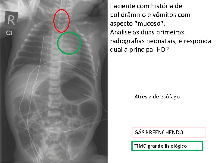 Paciente com história de polidrâmnio e vômitos com aspecto "mucoso". Analise as duas primeiras Paciente com história de polidrâmnio e vômitos com aspecto "mucoso". Analise as duas primeiras
