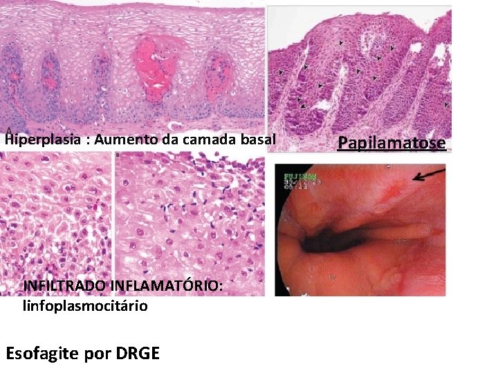 Hiperplasia : Aumento da camada basal INFILTRADO INFLAMATÓRIO: linfoplasmocitário Esofagite por DRGE Papilamatose Hiperplasia : Aumento da camada basal INFILTRADO INFLAMATÓRIO: linfoplasmocitário Esofagite por DRGE Papilamatose