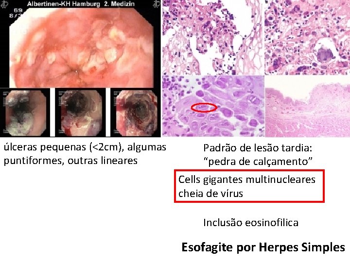 úlceras pequenas (<2 cm), algumas puntiformes, outras lineares Padrão de lesão tardia: “pedra de úlceras pequenas (<2 cm), algumas puntiformes, outras lineares Padrão de lesão tardia: “pedra de