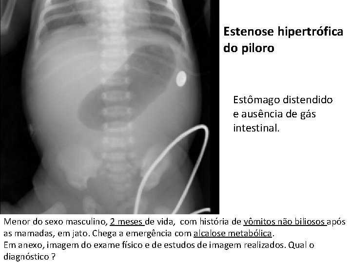 Estenose hipertrófica do piloro Estômago distendido e ausência de gás intestinal. Menor do sexo Estenose hipertrófica do piloro Estômago distendido e ausência de gás intestinal. Menor do sexo