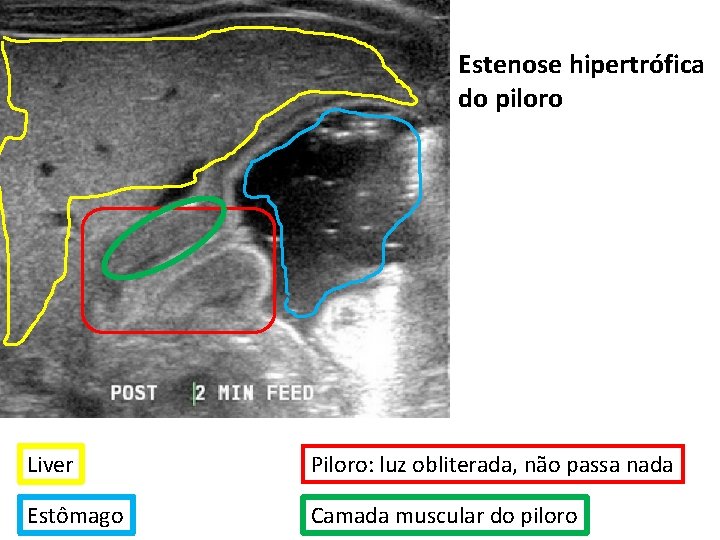 Estenose hipertrófica do piloro Liver Piloro: luz obliterada, não passa nada Estômago Camada muscular Estenose hipertrófica do piloro Liver Piloro: luz obliterada, não passa nada Estômago Camada muscular