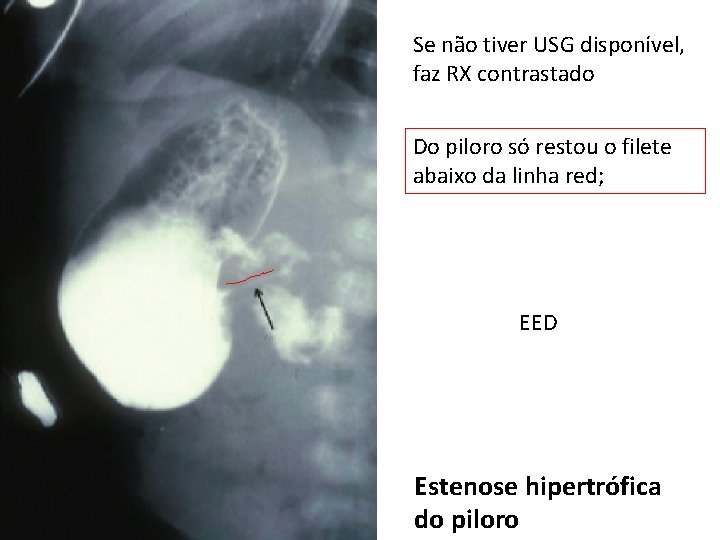 Se não tiver USG disponível, faz RX contrastado Do piloro só restou o filete Se não tiver USG disponível, faz RX contrastado Do piloro só restou o filete