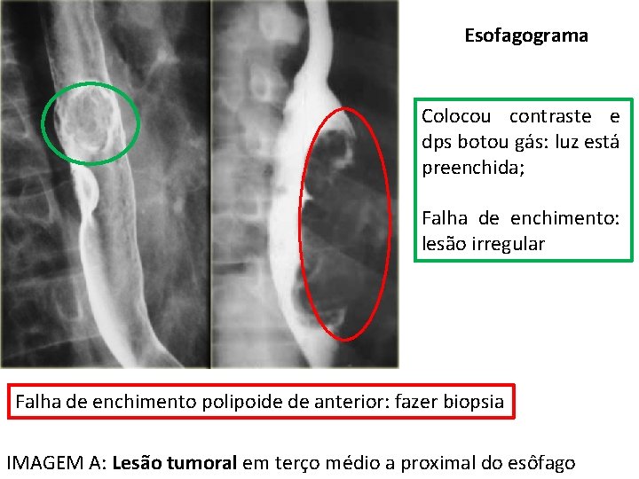 Esofagograma Colocou contraste e dps botou gás: luz está preenchida; Falha de enchimento: lesão Esofagograma Colocou contraste e dps botou gás: luz está preenchida; Falha de enchimento: lesão