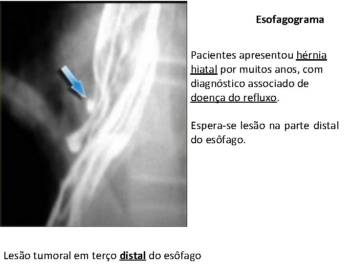 Esofagograma Pacientes apresentou hérnia hiatal por muitos anos, com diagnóstico associado de doença do Esofagograma Pacientes apresentou hérnia hiatal por muitos anos, com diagnóstico associado de doença do
