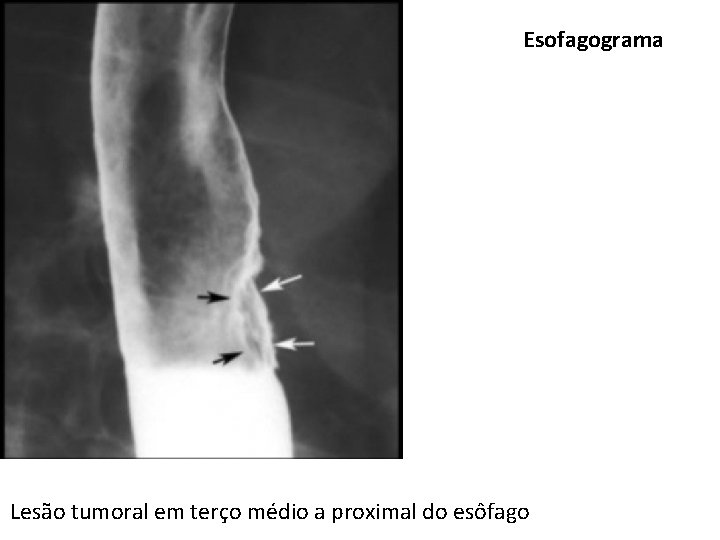 Esofagograma Lesão tumoral em terço médio a proximal do esôfago Esofagograma Lesão tumoral em terço médio a proximal do esôfago