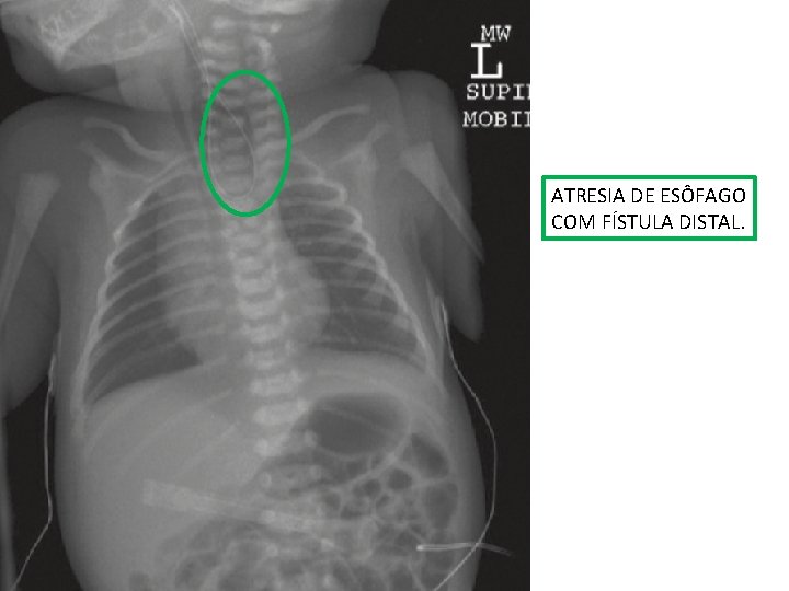 ATRESIA DE ESÔFAGO COM FÍSTULA DISTAL. ATRESIA DE ESÔFAGO COM FÍSTULA DISTAL.