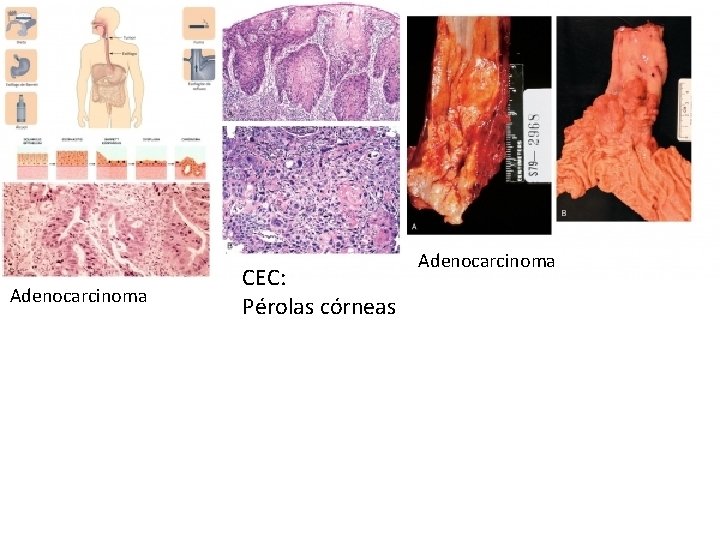 Adenocarcinoma CEC: Pérolas córneas Adenocarcinoma Adenocarcinoma CEC: Pérolas córneas Adenocarcinoma