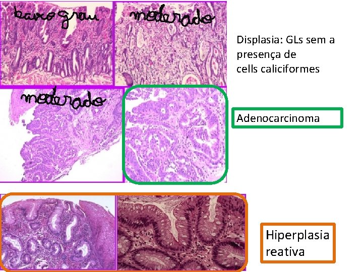 Displasia: GLs sem a presença de cells caliciformes Adenocarcinoma Hiperplasia reativa Displasia: GLs sem a presença de cells caliciformes Adenocarcinoma Hiperplasia reativa